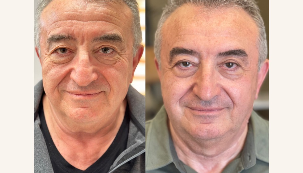 Bukkal masaj uygulama örneği 6