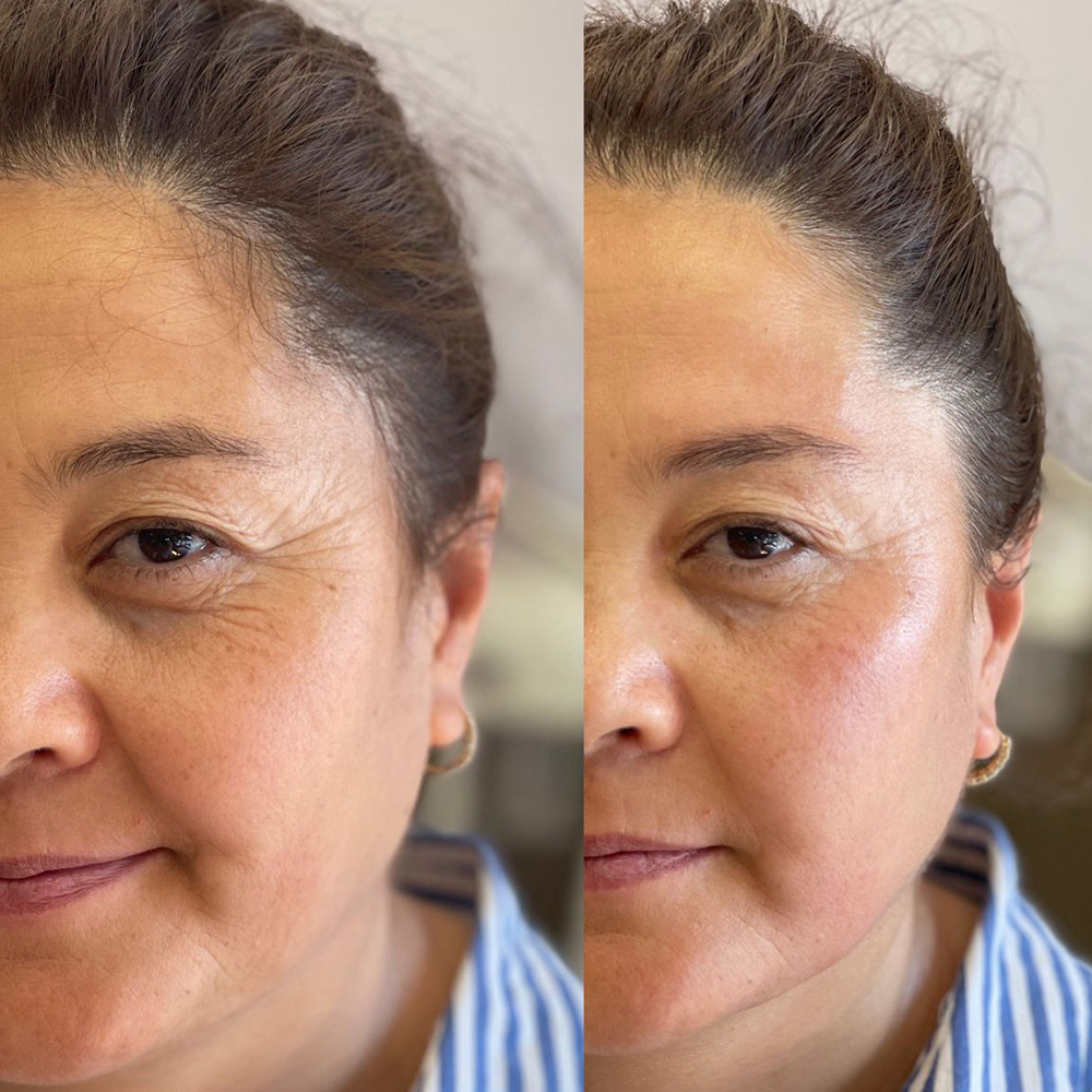 Bukkal & Yüz Masajı